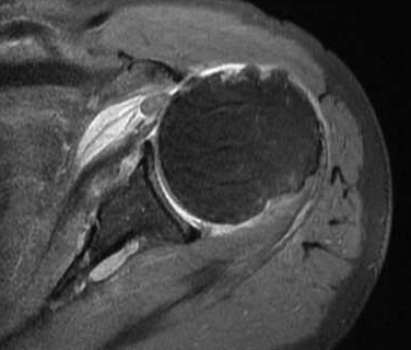 Biceps Medially Dislocated and Torn SSC